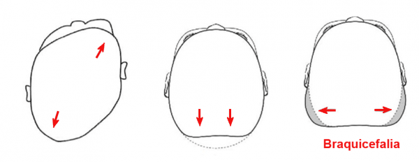 Dibujos plagiocefalia postural en horizontal