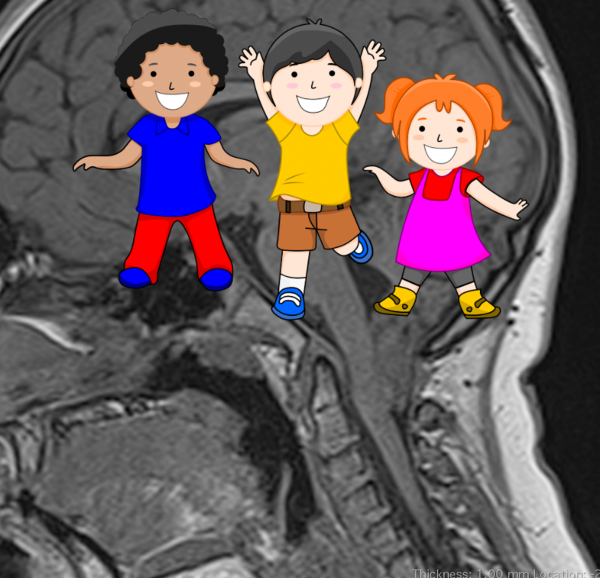 Chiari en niños