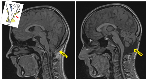 Lineas investigación Chiari