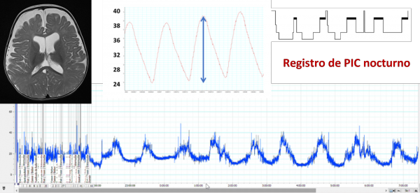 Lineas investigación Hidrocefalia